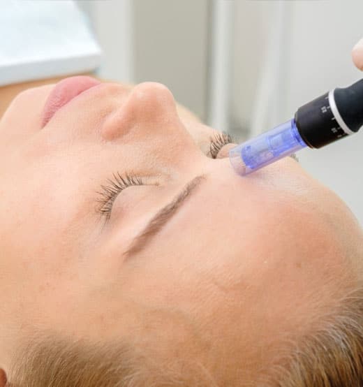 dermapen facial malaga