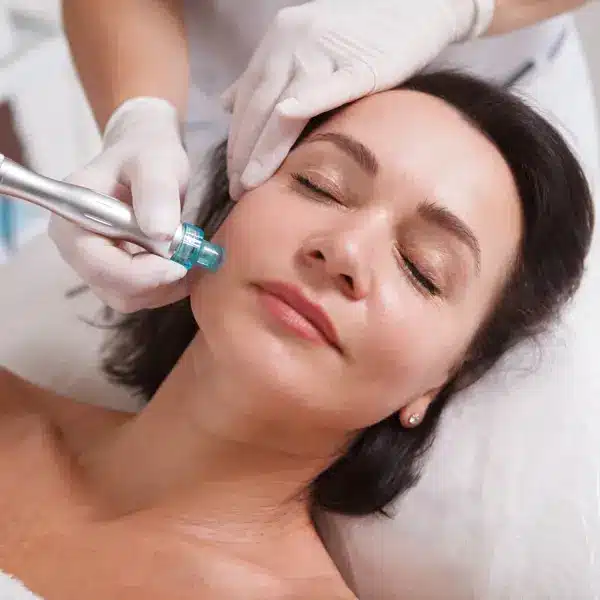 microdermoabrasion radiofrecuenncia