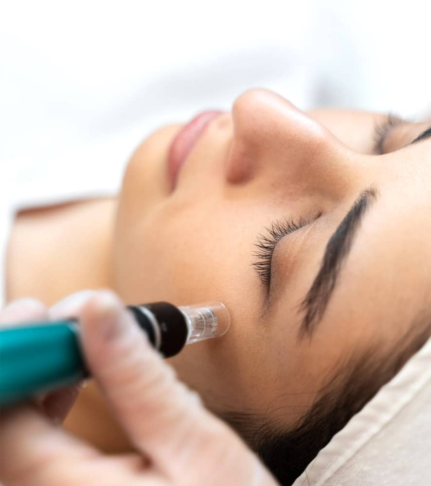 dermapen facial malaga