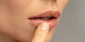 dermapen para labios malaga centro